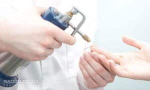 Crioterapia DERMATOLOGIA, Servizi, VISITE SPECIALISTICHE Centro Dermatologico