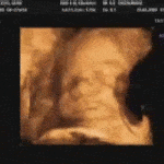 Ecografia Ostetrica bidimensionale e 3D-4D